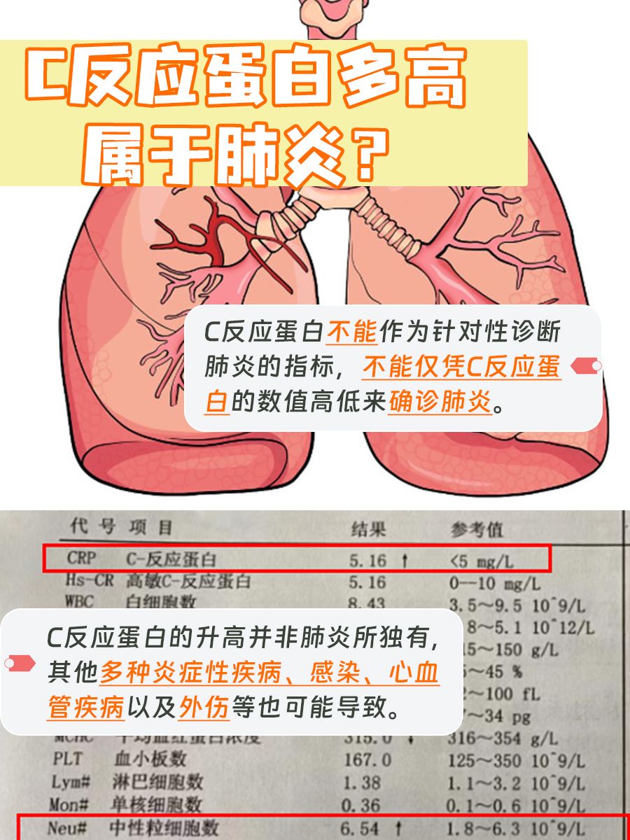 C反应蛋白预警！数值多少是肺炎的“红灯”？