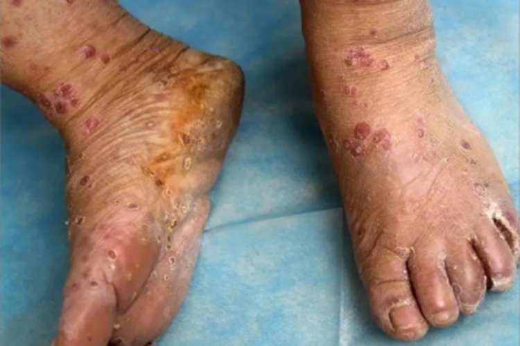 三期梅毒脚部脱皮图 三期梅毒脚部脱皮图