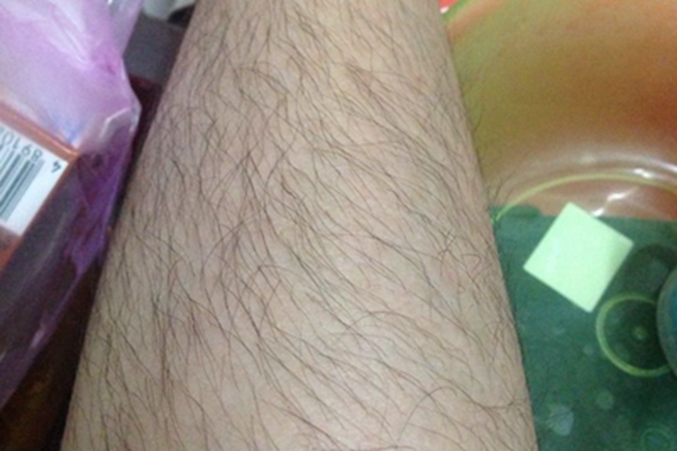 妇女多毛症小腿汗毛又多又长图