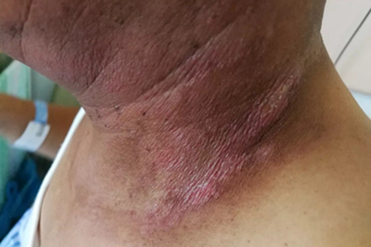 急性放射性皮炎颈部皮肤萎缩图