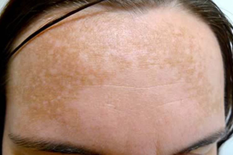 家族性进行性色素沉着症状图