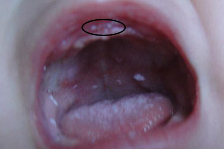 鹅口疮牙龈起白泡图