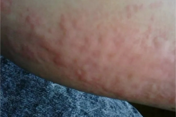 延迟性压力性荨麻疹红斑图