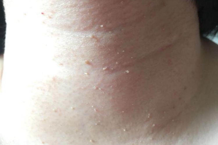 脖子粟丘疹图 脖子粟丘疹图