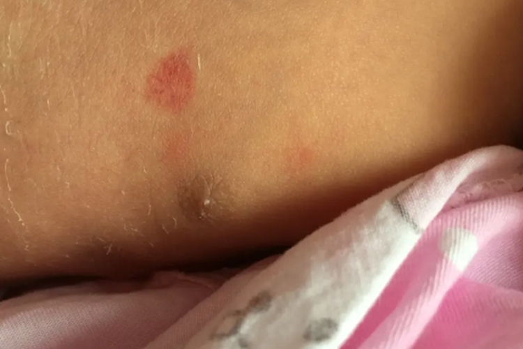 前胸部鲜红斑痣图