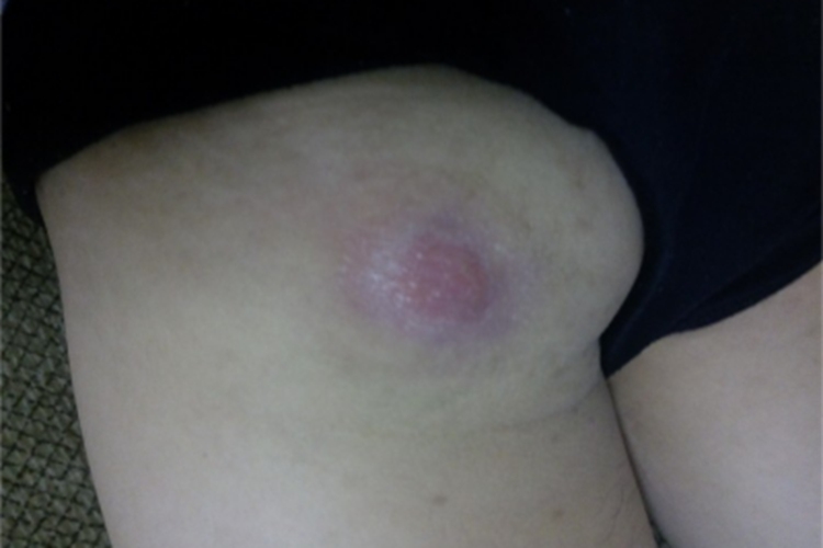 皮脂腺囊肿屁股长疙瘩图