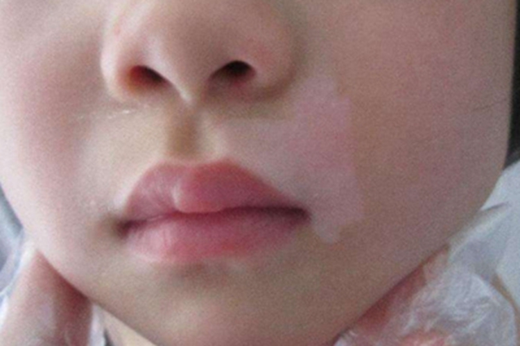 稳定期节段型白癜风白斑图 稳定期节段型白癜风白斑图