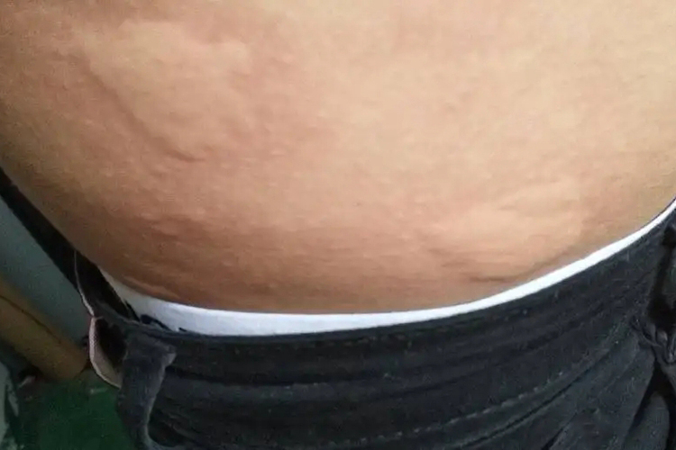 胯部荨麻疹图 胯部荨麻疹图