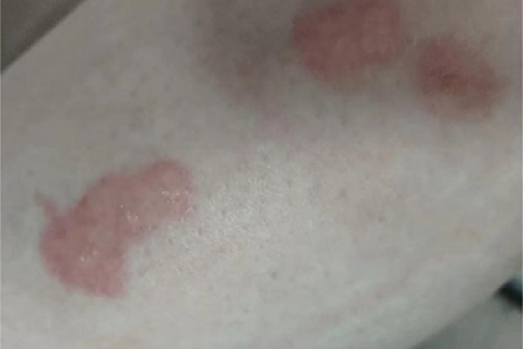 虫咬皮炎小腿大红疙瘩图