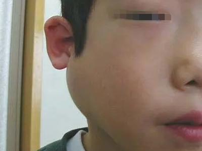 儿童复发性腮腺炎腮帮子肿大图.jpg
