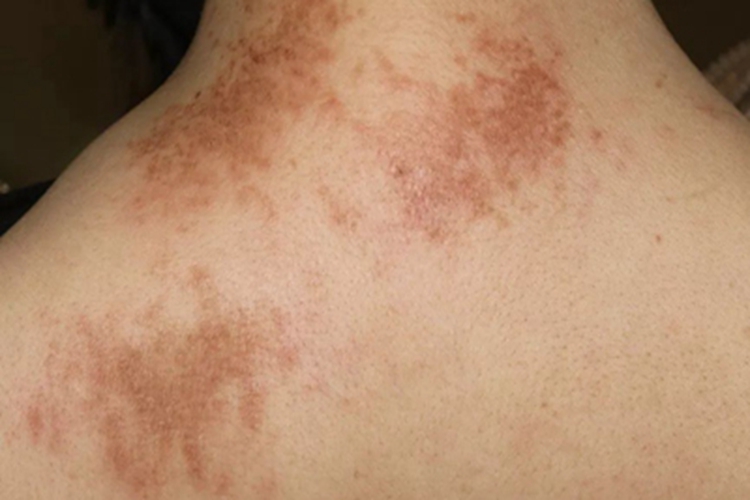 成人Still病背部风团图 成人Still病背部风团图