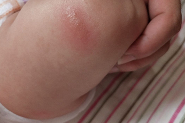 婴儿被蠓叮咬腿上有红斑图