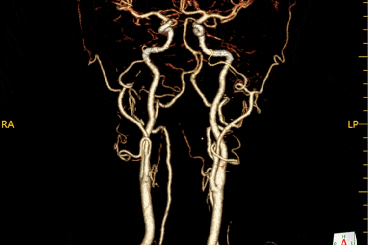 正常颅脑血管CTA影像图 正常颅脑血管CTA影像图