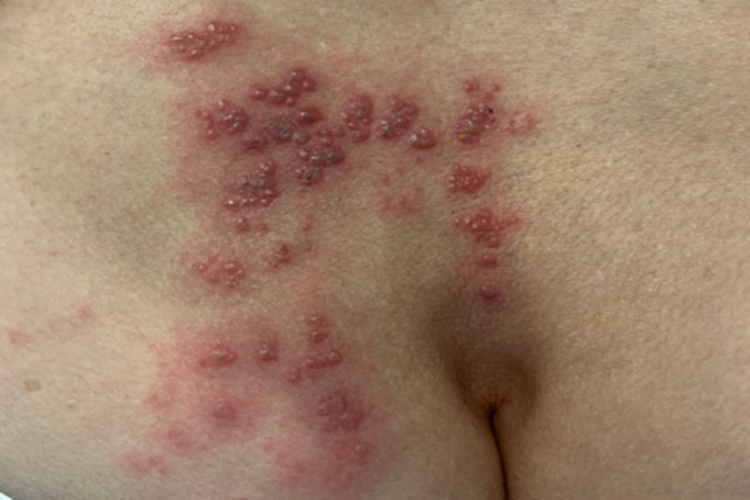 艾滋病感染性皮肤损害臀部症状图