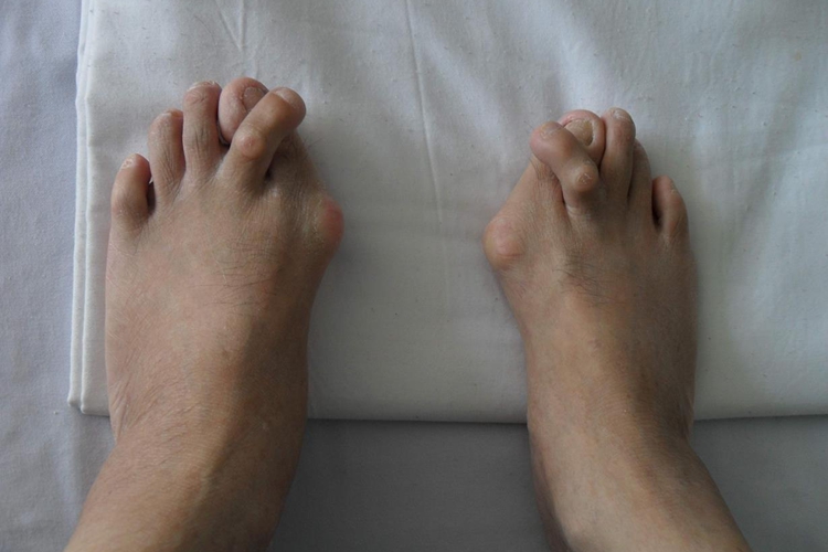 大拇趾畸形阶段图