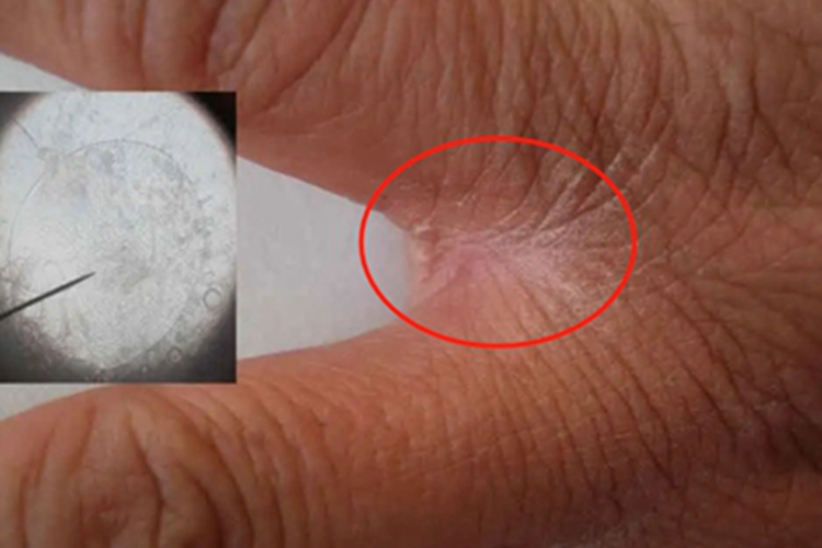 结痂性疥疮手指缝症状图