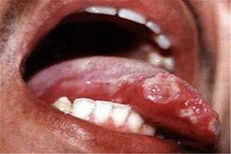 白塞病溃疡图 白塞病溃疡图