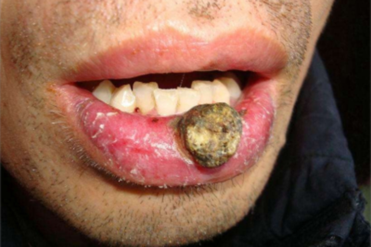 皮肤鳞状细胞癌嘴唇症状图