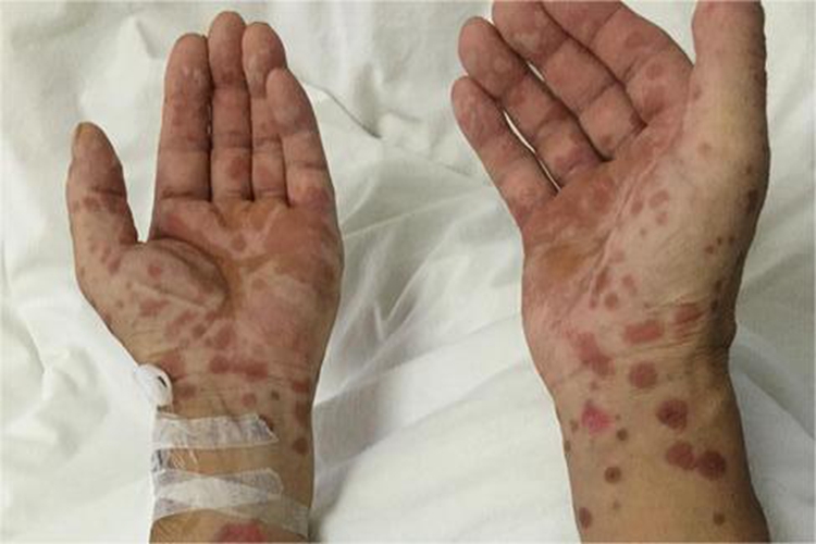 多形红斑型药疹手掌症状图