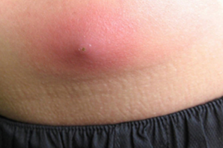 疖肚皮上红色硬疙瘩图