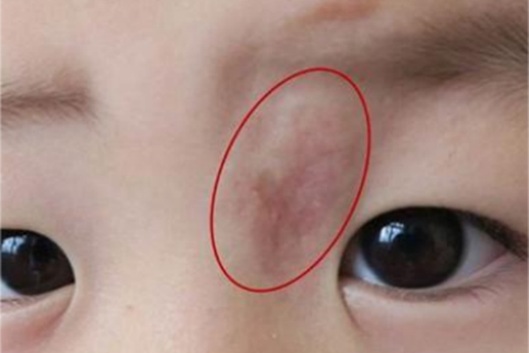 眼睑毛细血管瘤眼周症状图