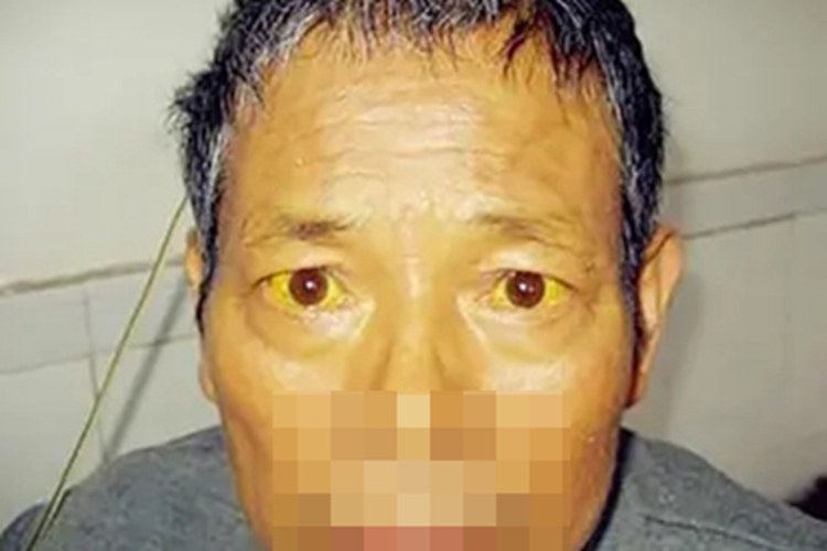 结节性液化性脂膜炎黄疸图 结节性液化性脂膜炎黄疸图