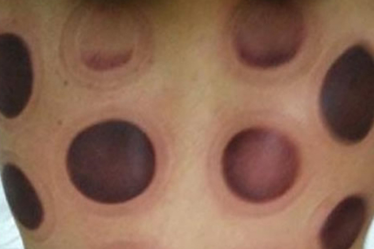 女性背部拔罐后黑紫图