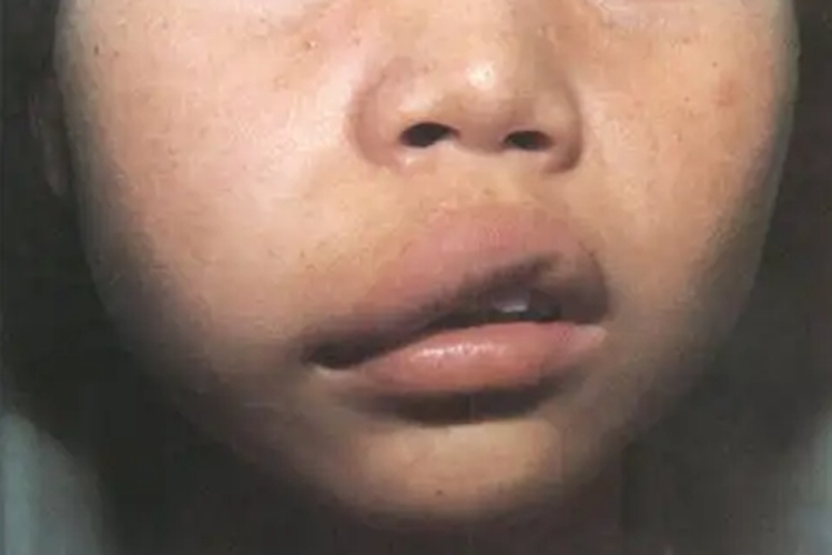 海绵状淋巴管瘤图