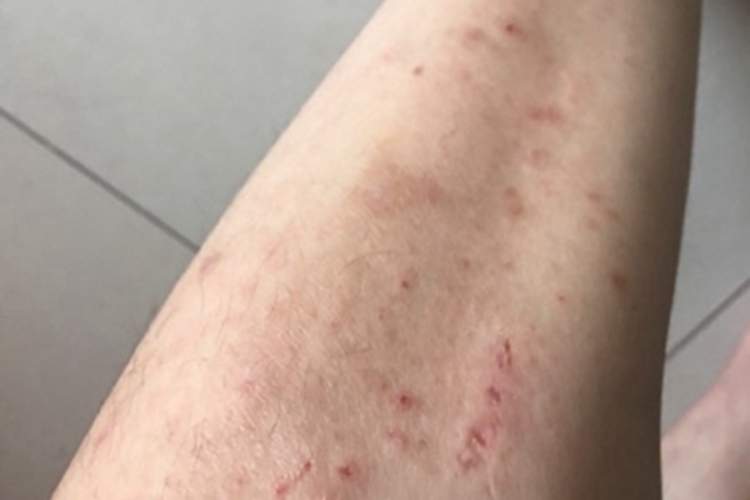 色素性痒疹疙瘩图 色素性痒疹疙瘩图