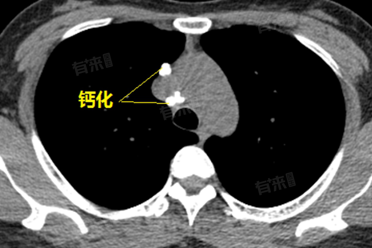 肺部钙化灶是怎么回事,严重吗