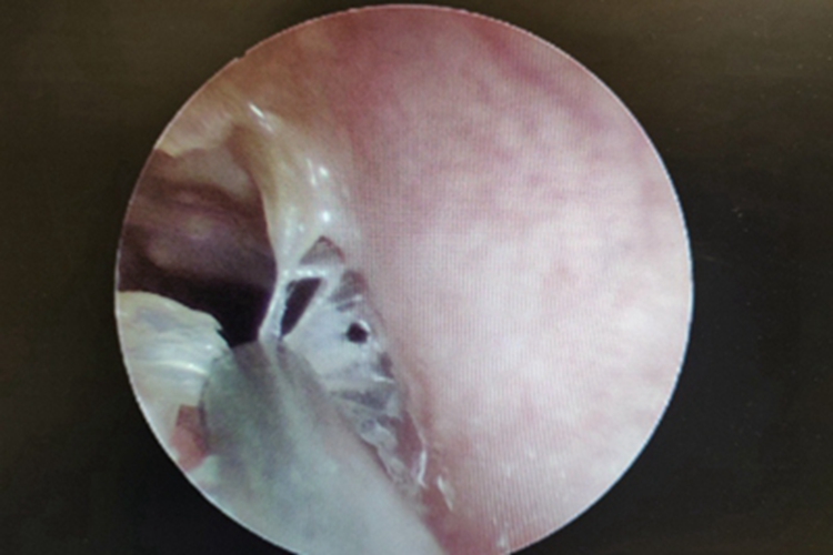 霉菌性外耳道炎外耳道化脓图 霉菌性外耳道炎外耳道化脓图