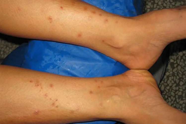 动物血吸虫尾蚴皮炎腿部丘疹图