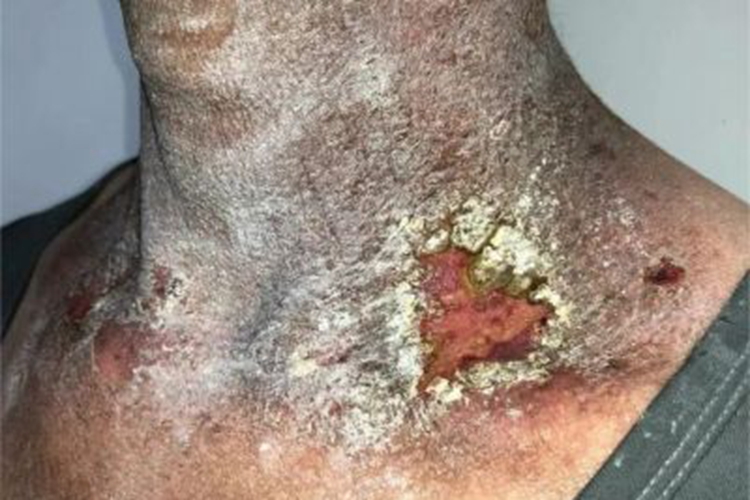 急性放射性皮炎出现溃疡图