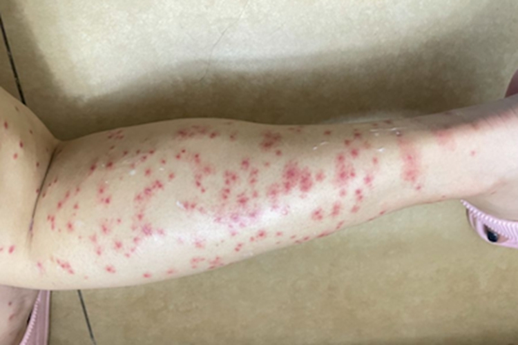 蠓虫叮咬引起的皮肤反应丘疹图