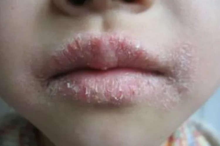剥脱性唇炎嘴唇脱皮图
