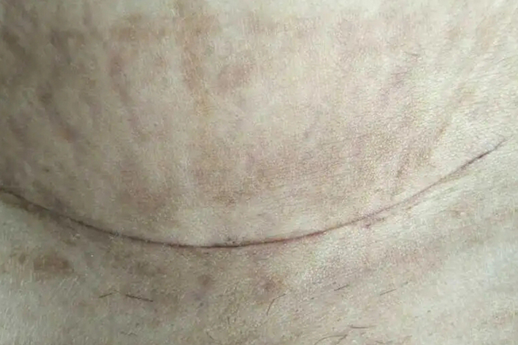 剖宫产早期刀口图