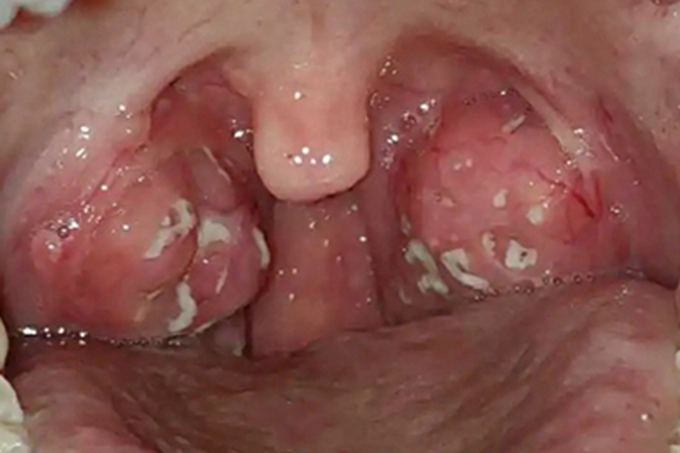 化脓性扁桃体炎扁桃体症状图