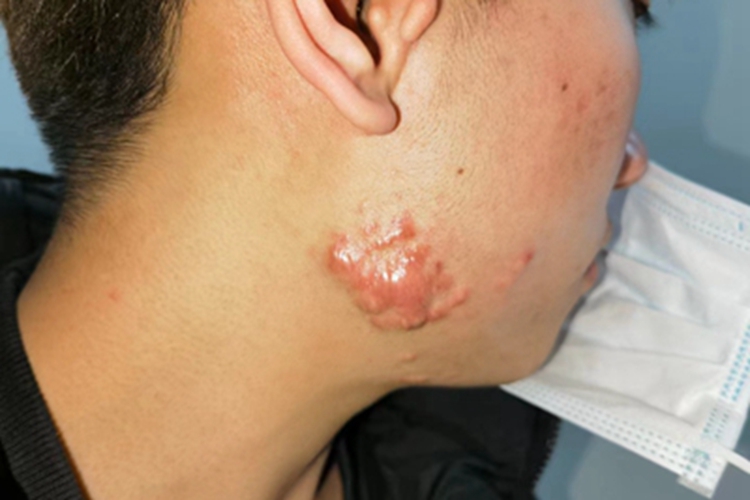 瘢痕疙瘩面部瘢痕图