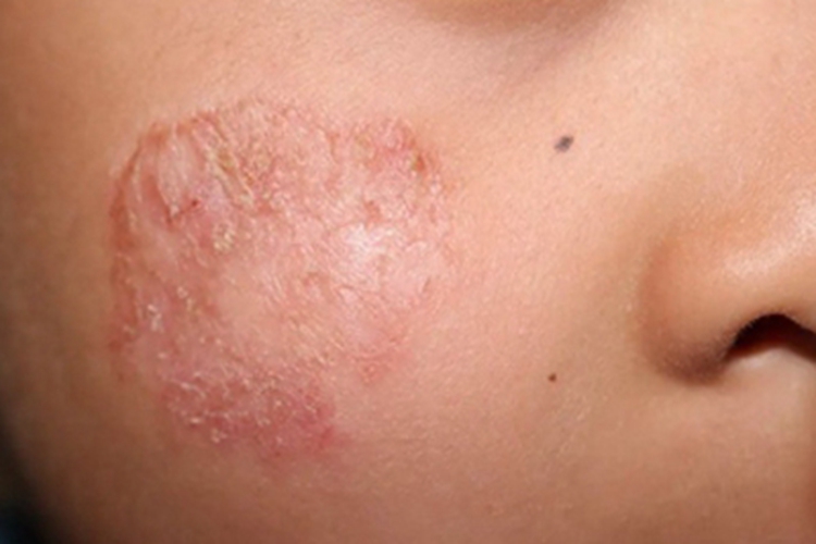 离心性环状红斑面部脱皮图