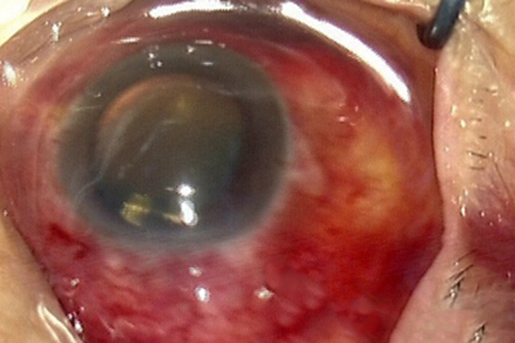 玻璃体疝眼球充血图