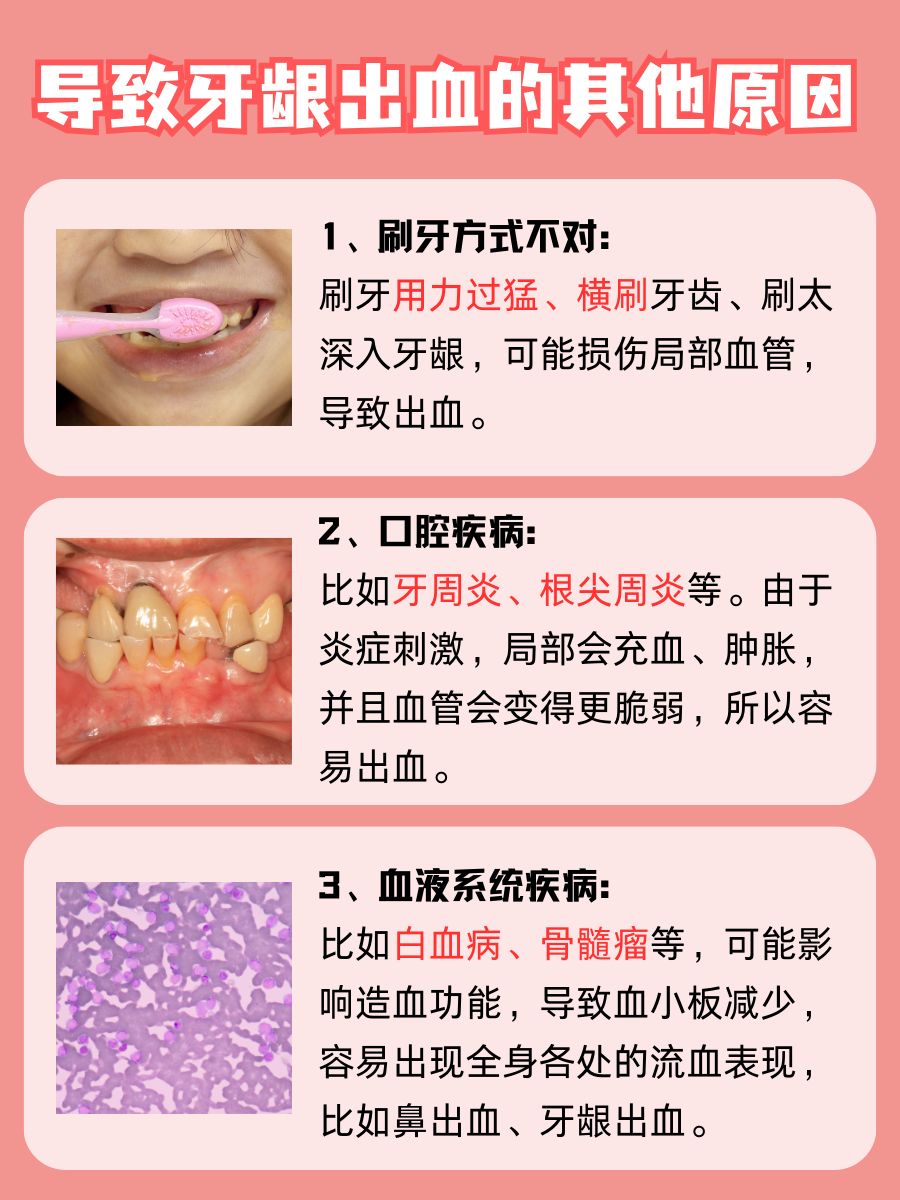 牙龈出血频发？你可能缺了这些关键营养素！