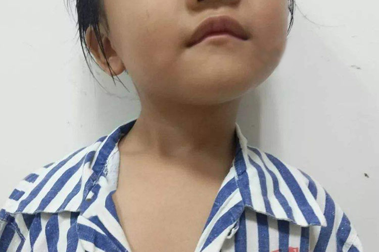 斜颈孩子长大后图