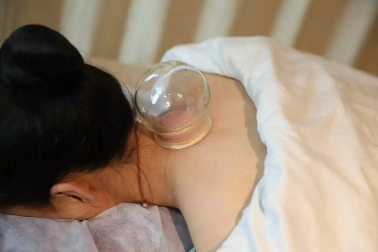 大椎穴拔罐图 大椎穴拔罐图