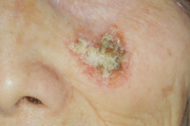 光线性角化病面部结痂图