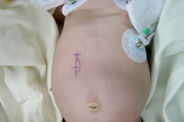 蛙状腹图 蛙状腹图