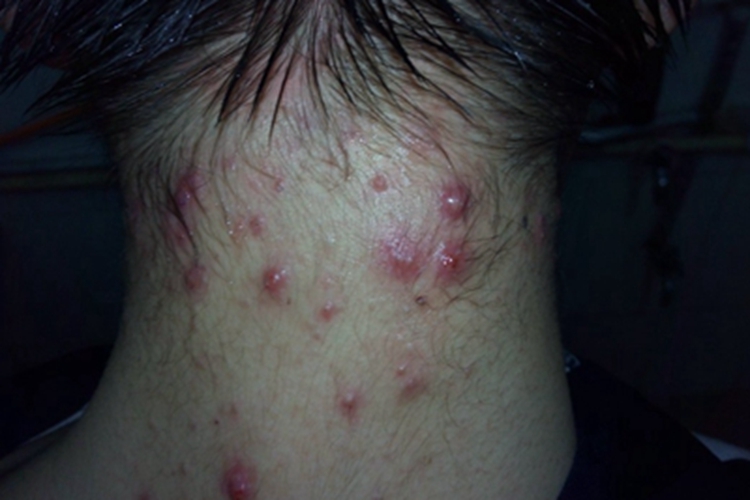 暴发性痤疮后颈症状图 暴发性痤疮后颈症状图