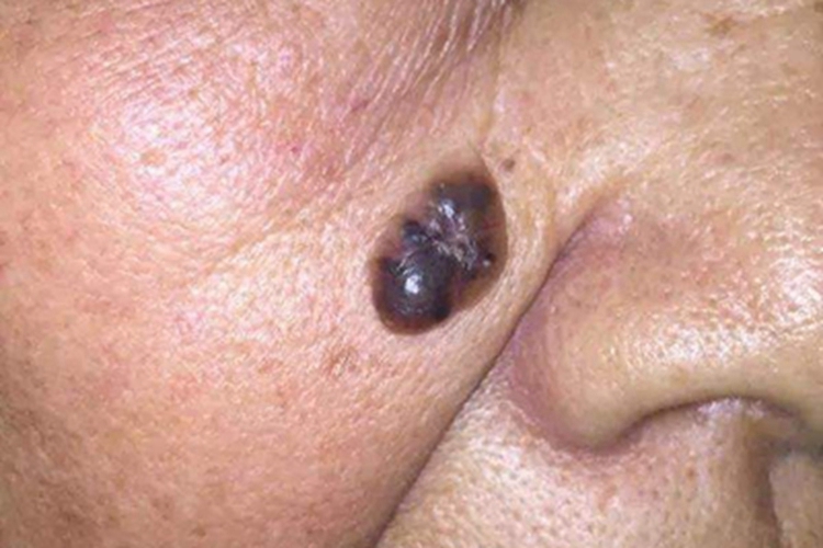 基底细胞痣综合征面部症状图