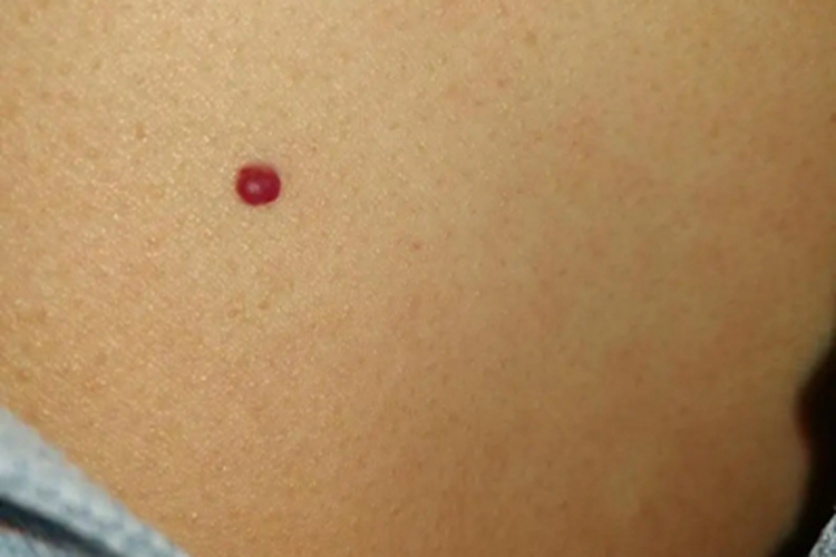 樱桃状血管瘤大腿症状图