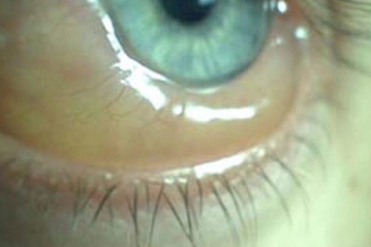 细菌性结膜炎结膜水肿图