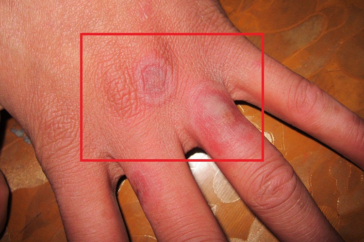 寒冷性脂膜炎水疱图